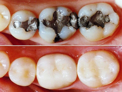 Tooth Coloured fillings